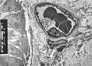 jejunum … lipid malabsorption jejunum … lipid malabsorption